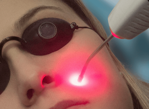 Laserterapia 
